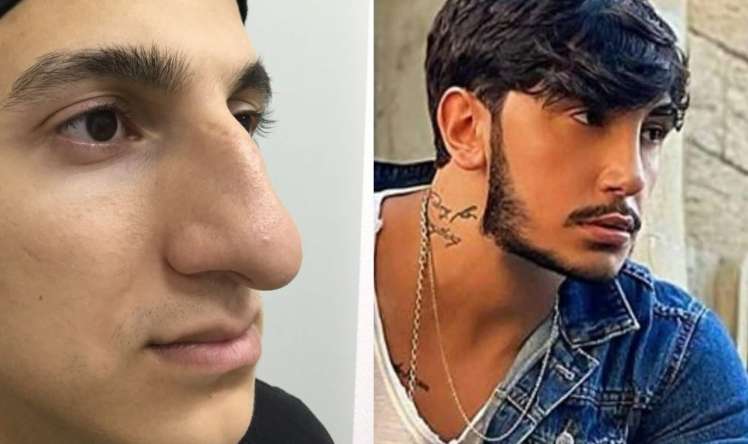 LOR cərrah stilistin yalanını üzə çıxardı  -  Əvvəlki burnu ilə müqayisə edin - FOTOFAKT