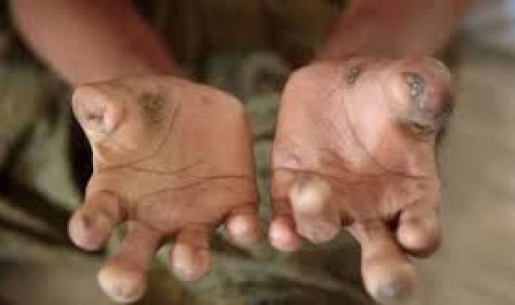 Azərbaycanda aşkarlanan qeyri-adi nadir xəstəliklər 