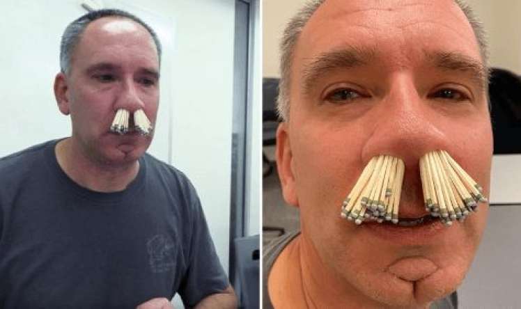  Təcili yardım həkimi burnuna 91 kibrit saldı 