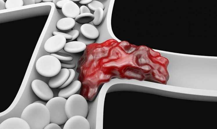 Qəfil nəfəs tıxanması  tromb əlaməti    ola bilər