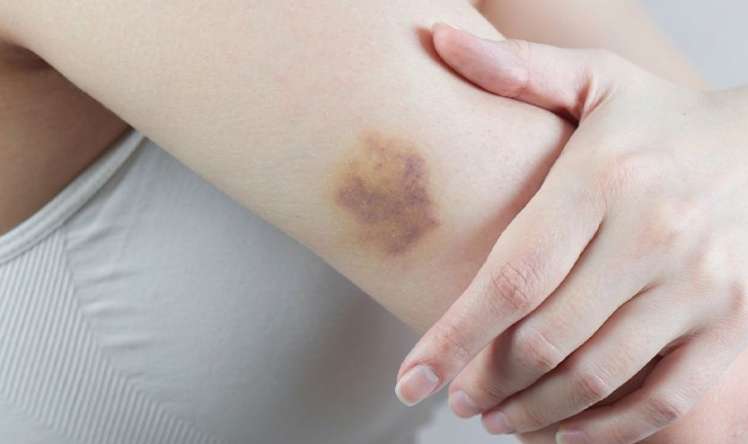 Əl-ayaqda səbəbsiz göyərmələr  – Nə çatışmır?