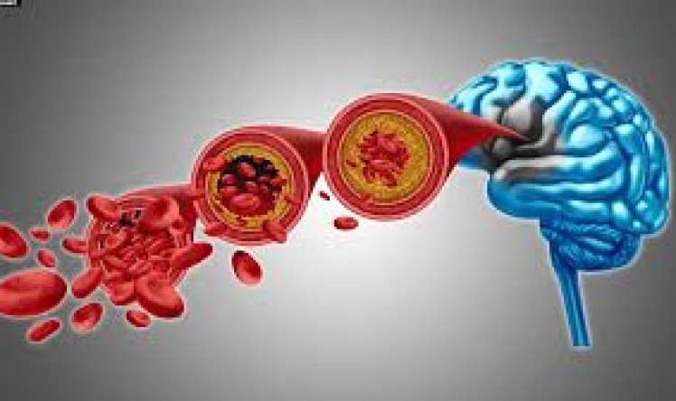 Beyninə qan az gedir?    - Bu əlamətlər varsa...