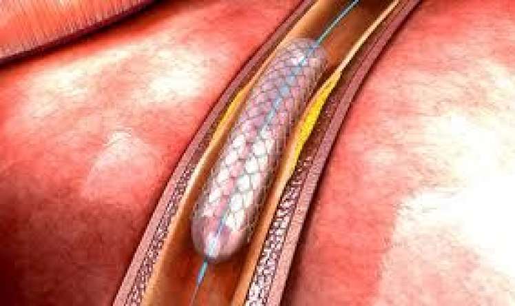 Ürəyə stent hansı hallarda qoyulur? 