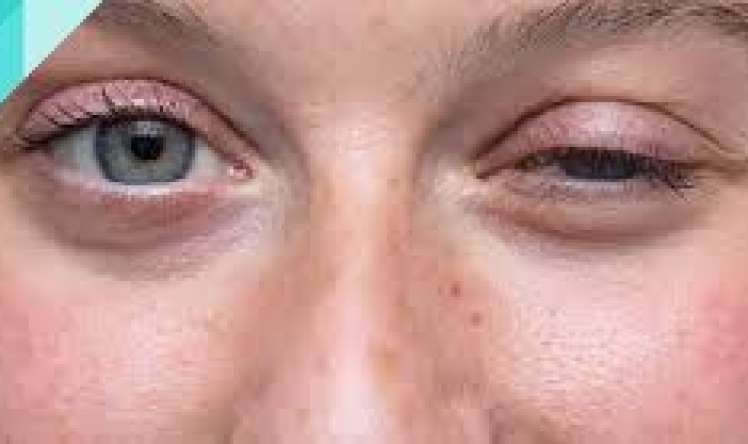 Miasteniya qaraciyərdə yağ yığılmasından    ola bilər