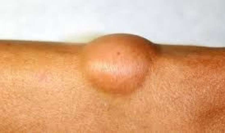 Lipoma –jirovik nədir və niyə yaranır? 