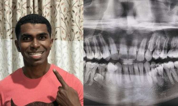 Kişinin ağzında 42 diş çıxıb 