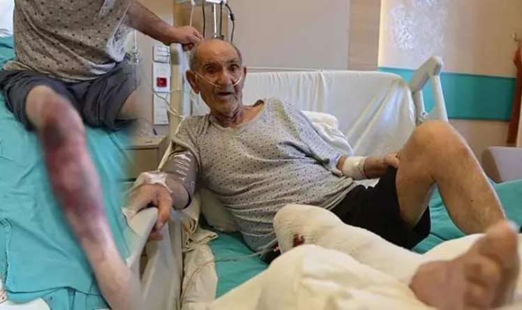 Təmizləyicisi vasitə ayağını yandırdı -  Xəstəxanalıq oldu-FOTO