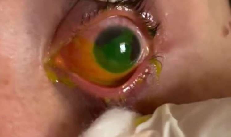 Gözünə potaş məhlulu töküldü, yandı -  VİDEO