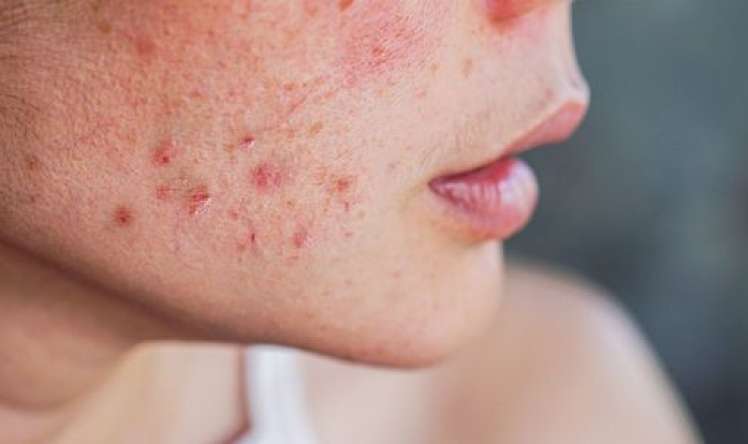 Sızanaqları kökdən yox edən  təbii formula