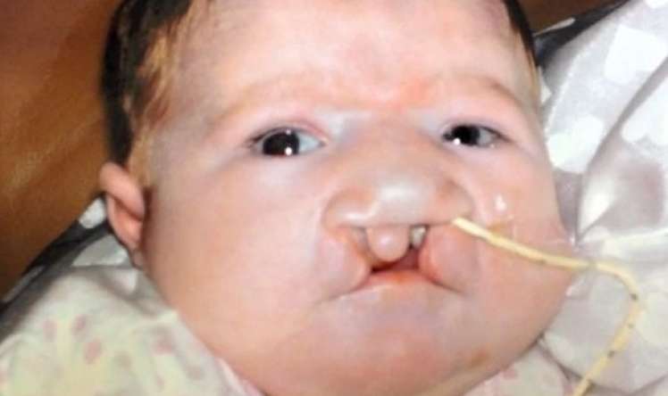 13 mart – Dünya Patau Sindromu günü  – Nadir genetik xəstəlik