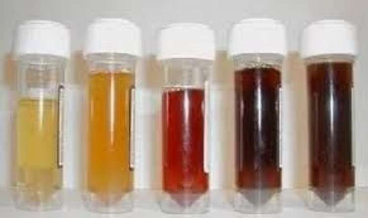 Sidiyin bu rəngi qaraciyərin ağır zədələndiyini göstərir 