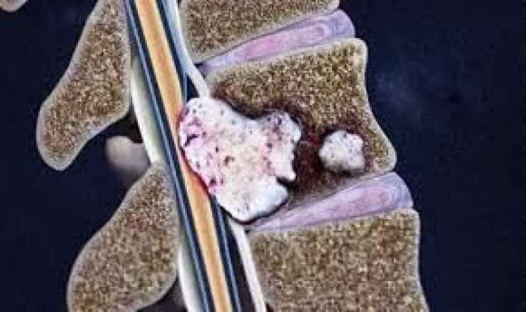 Xərçəngin metastaz verdiyini göstərən    - 5 Əlamət