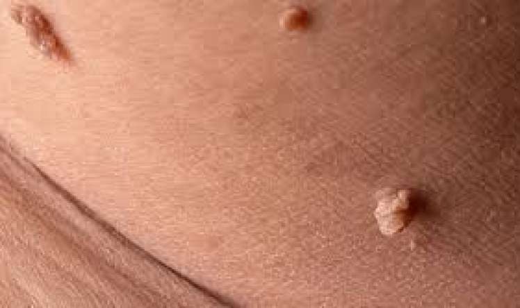 Cinsi orqandakı ziyillər xərçəngə çevrilir? 