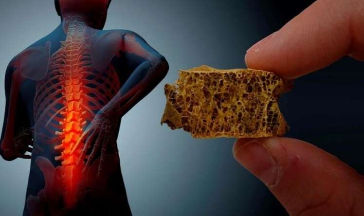  Hər üç kişidən birinin sümükləri zəifdir 