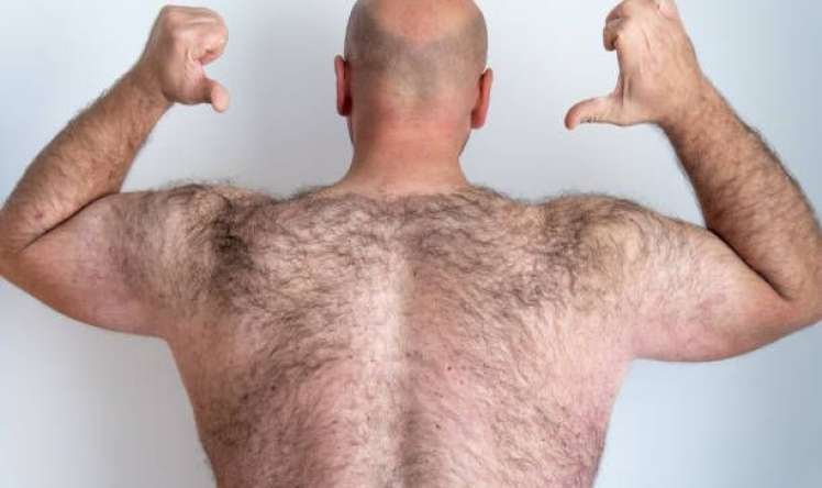 Kişilərdə həddindən artıq tüklənmə  - Səbəblər