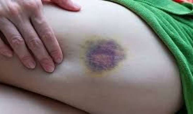 Bədəndə göyərmə, qançırlar sağalmır?   – Bu orqanı yoxlat