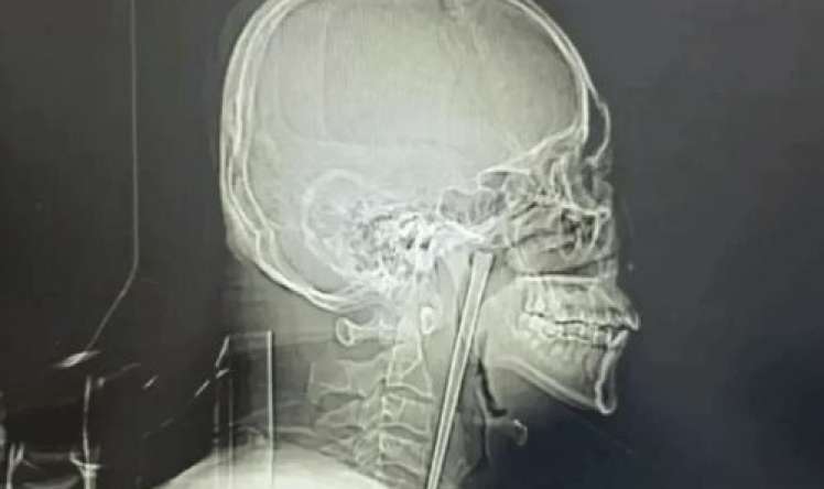 Yemək çubuğunu udan kişi 8 il həkimə getməyib 