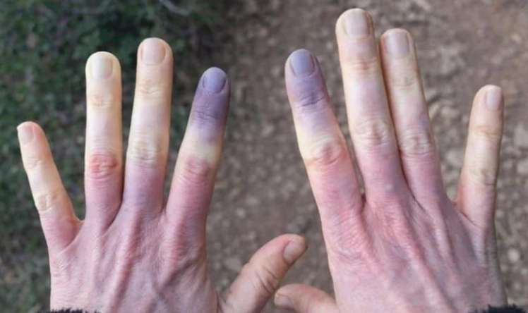 Sadəcə üşüdüyünüzü düşünməyin:  Əlləriniz göyərirsə...