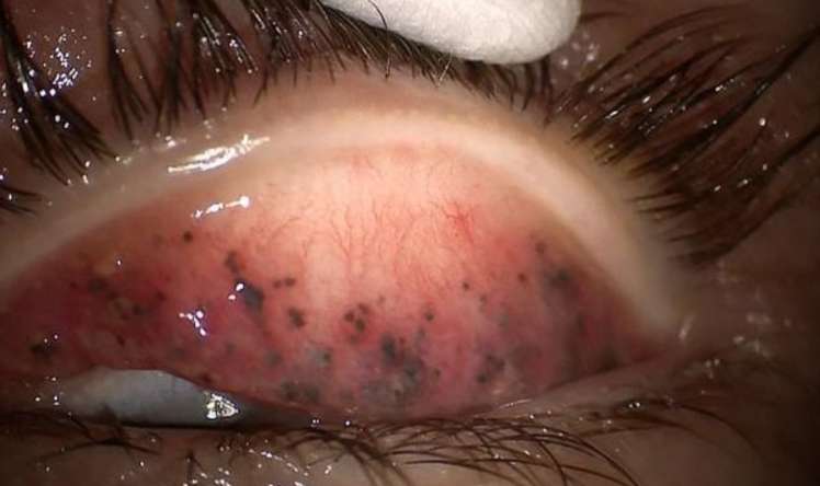 Makiyajı silmədən yatan qadının gözü -  Mütəxəssisdən xəbərdarlıq