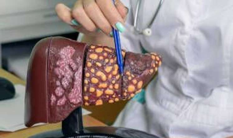 Yağlı qaraciyərdə nə kömək edir? 