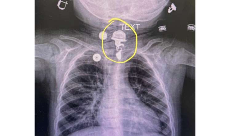 16 aylıq uşaq boyunbağı uddu -  FOTO