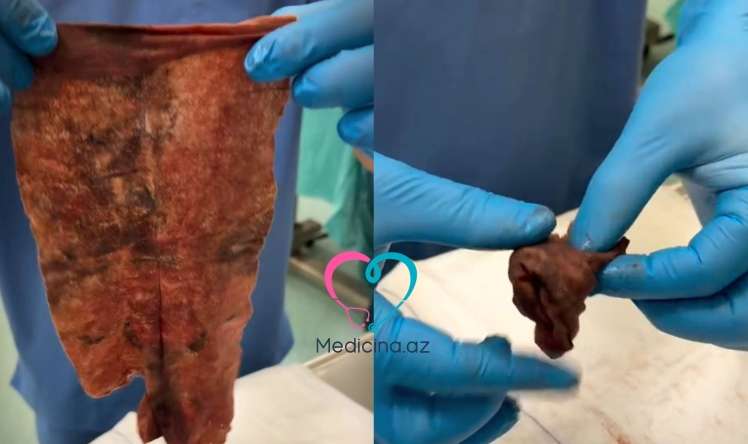 Vaginaya salfet qoyan qadın ağır infeksiyaya yoluxdu -  VİDEO