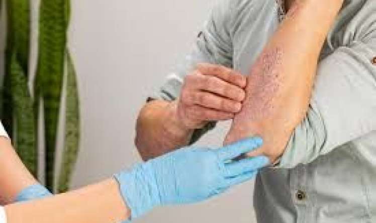 Psoriaz və göbələyin yeni müalicəsi    tapıldı