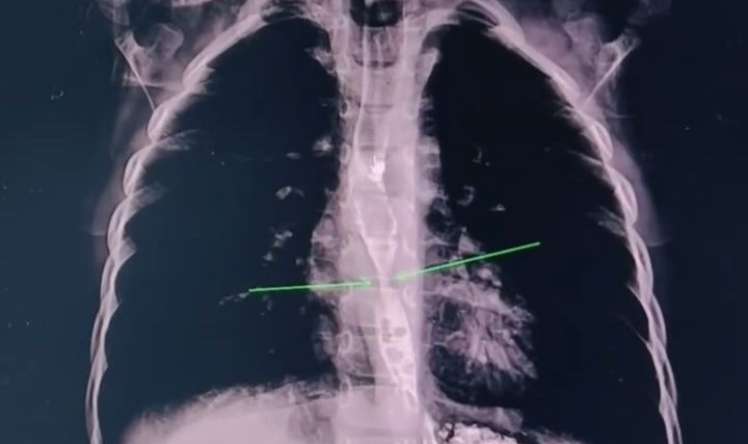 2 yaşlı uşaq yağ çözücü içdi - Daxili orqanları yandı -  VİDEO