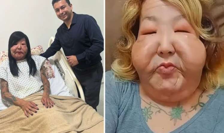 Gözəllik naminə üzü tanınmaz hala gəldi -  FOTO