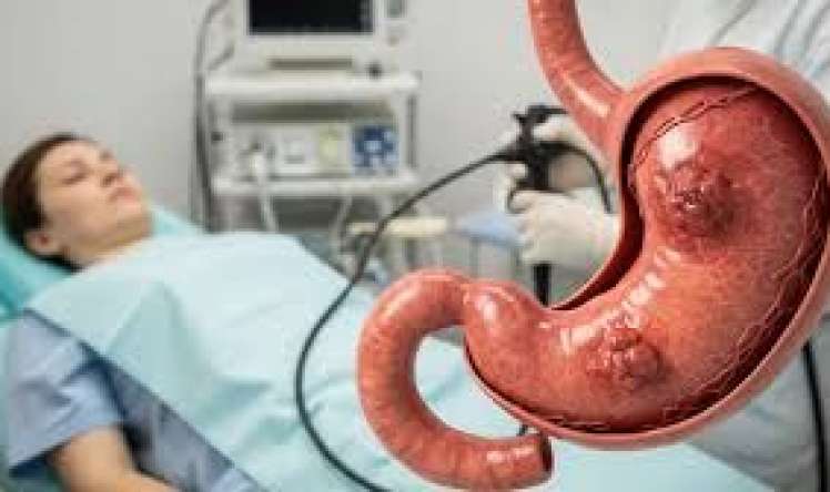 Bu qidalar mədə xərçəngini artırır 