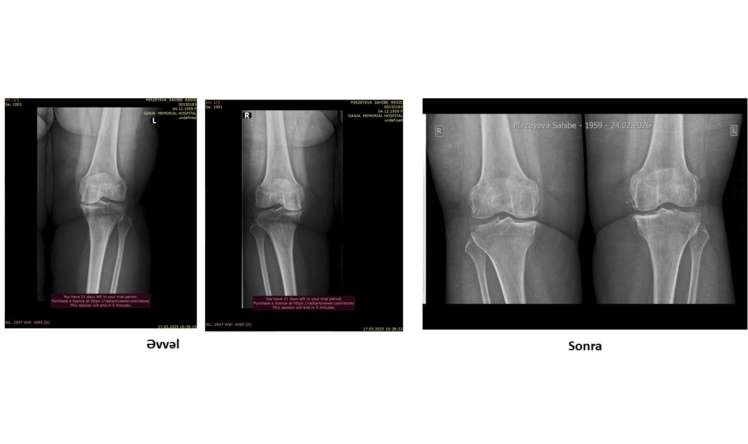 Protez təklif edildi, amma əməliyyatsız sağaldı –  Real pasiyent hekayəsi-VİDEO