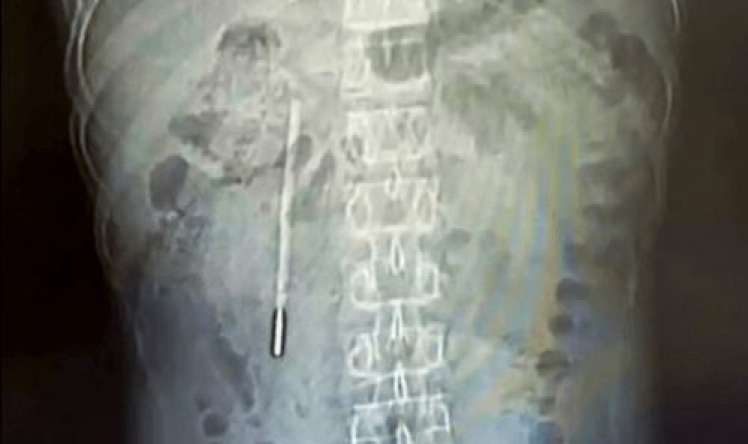 Uşaq vaxtı udduğu termometr  – 20 il sonra çıxarıldı