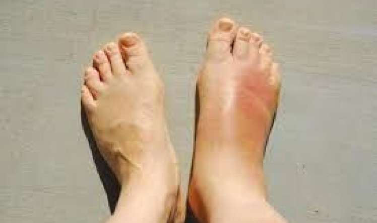 Topuq nahiyəsində şişkinlik və ağrı   - Səbəblər