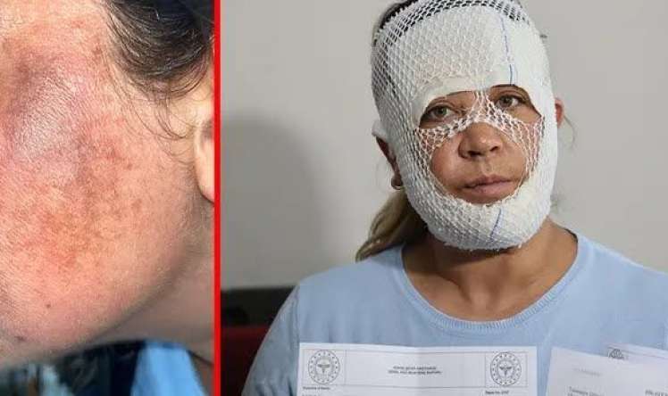 "Prenses baxımı" kabusa çevirdi -  Qadının üzü yandı-FOTO