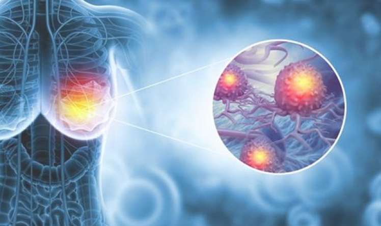 Mamoqrafiya “təmiz” olsa da, xərçəng necə aşkarlandı? -  Real pasiyent hekayəsi-VİDEO