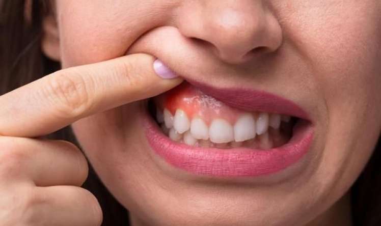 Diş ətiniz qanayırsa, bu vitamin  çatışmır 