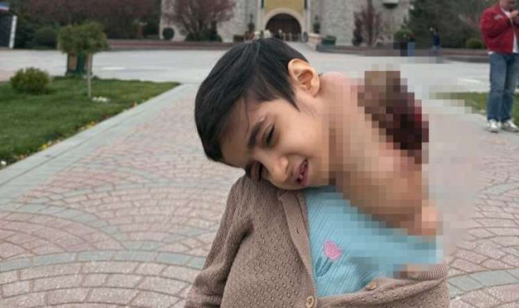 Dünyada ilk -  Uşağın boynundan 3 kiloqramlıq şiş çıxarıldı