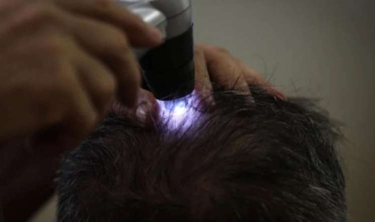 Qədim Çin otu  keçəlliyin müalicəsi ola bilər 