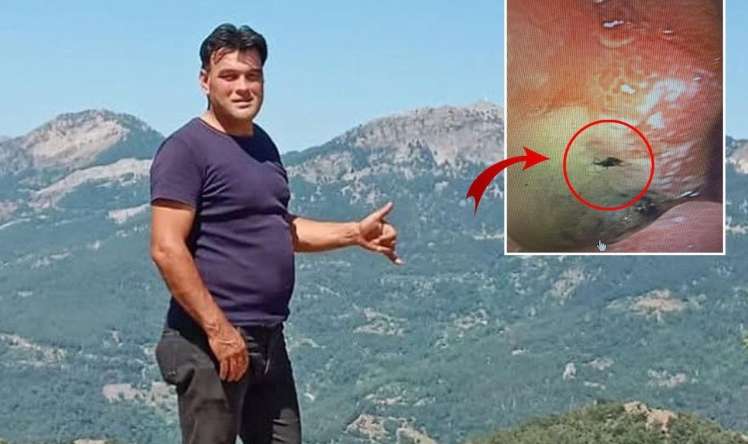 Kabus kimi bir hadisə -  Mədəsindən canlı həşərat çıxarıldı