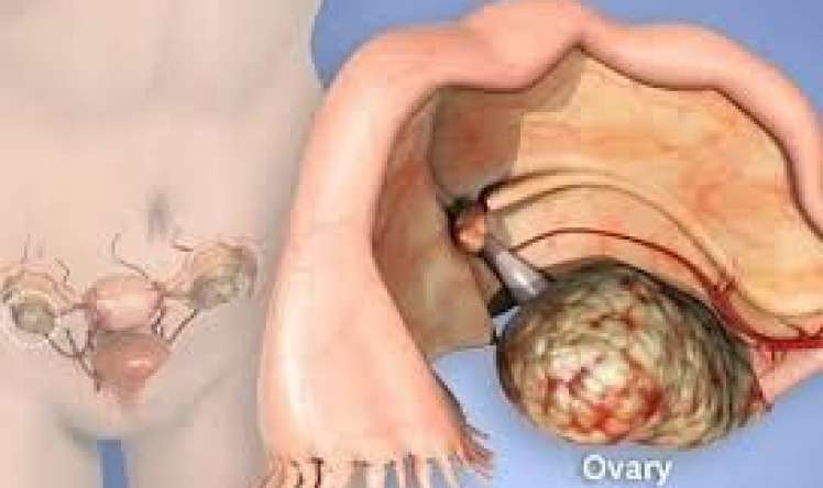 40 yaşından yuxarı qadında bel ağrısı  xərçəngdən də ola bilər