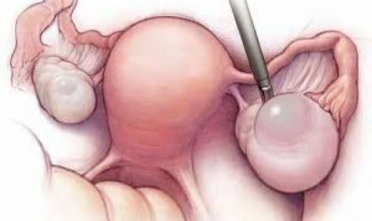 20 yaşlı qızdan qarpız böyüklükdə  kista çıxarıldı 