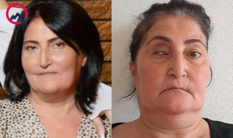 Bu klinika təzminat ödəyəcək -  Burun düzəldəndə gözü zədələyib