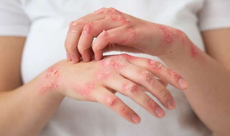 Dəri problemlərinin arxasında nə dayanır? -  Yüksəkdozalı Vitamin C ilə antioksidant müdafiəyə dəstək