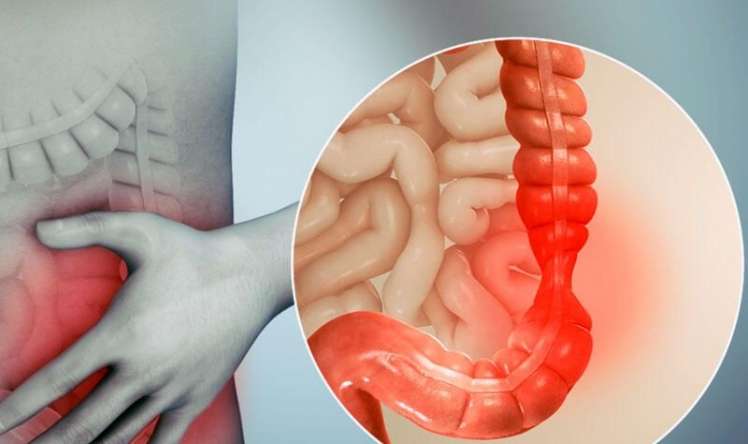 Hemoroid bildi,  xərçəng çıxdı