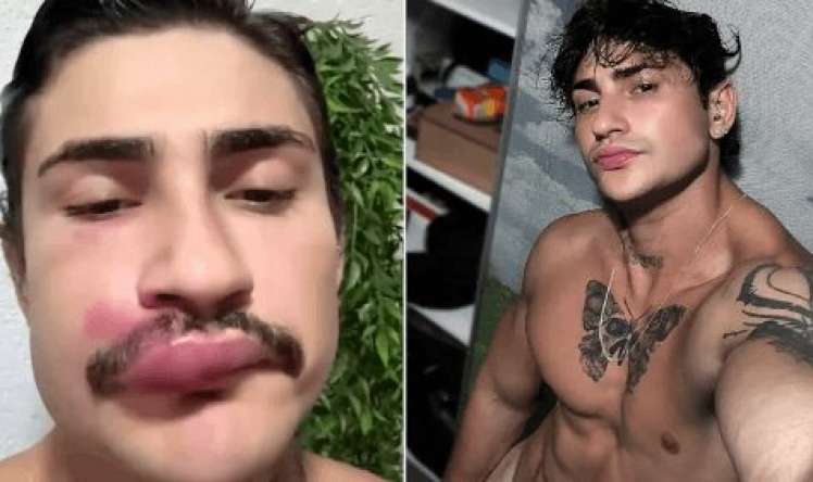 Dodağındakı sızanağı sıxdı, xəstəxanalıq oldu 