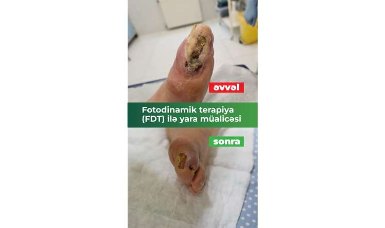 Ayağı kəsilməkdən xilas edən müalicə:  Fotodinamik terapiya (FDT) ilə diabetik yaralarda sürətli sağalma