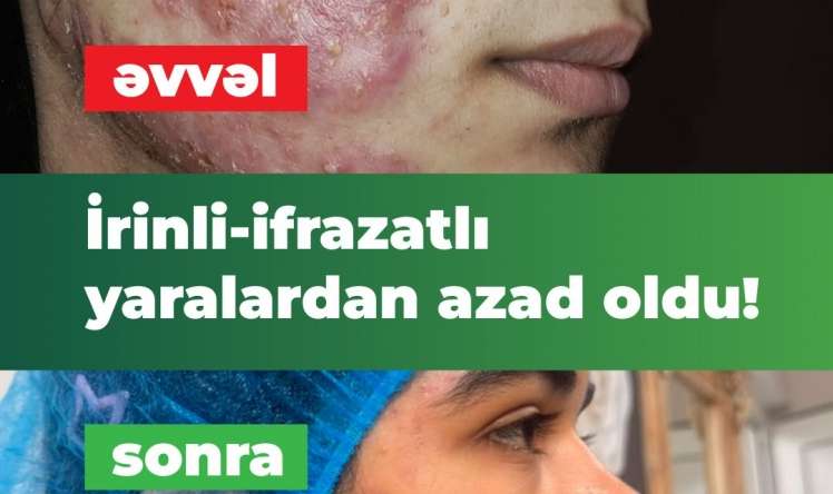 İltihablı sızanaqlar yeniyetmənin həyatını alt-üst etmişdi.  İnteqrativ müalicə ilə həll yolu tapıldı - VİDEO