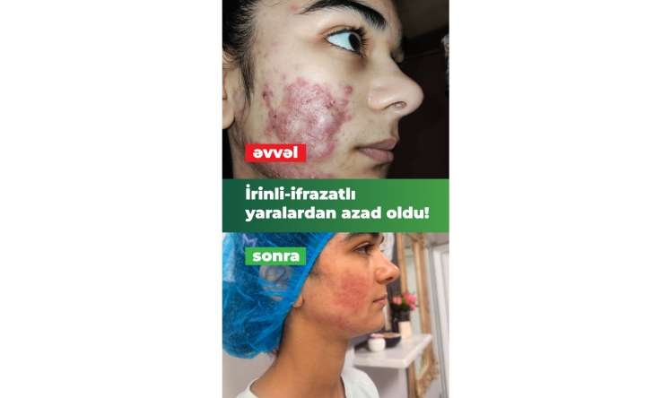 İltihablı sızanaqlar yeniyetmənin həyatını alt-üst etmişdi.  İnteqrativ müalicə ilə həll yolu tapıldı - VİDEO