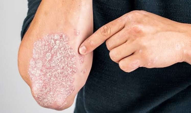Psoriaz niyə təkrarlanır? -  Mütəxəssis səbəbləri açıqladı - VİDEO