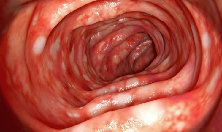  Xoralı Kolitə yeni yanaşma:  Gündə 16–20 dəfə ishal yaşayan xəstənin vəziyyətində dəyişiklik